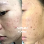 Hình ảnh Thực Tế Review Combo Giảm Mụn Viêm Mủ Biotrade Acnaut - 1Market.com.vn