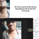 Vết Sẹo Mổ Của Người Bị Tiểu đường Dùng Mpower Hỗ Trợ - 1Market.com.vn